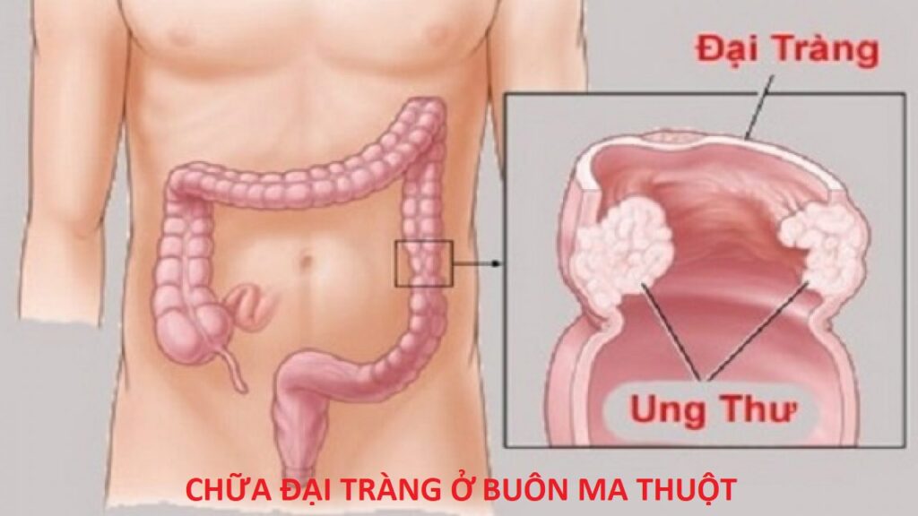 Chữa đại tràng ở Buôn Ma Thuột