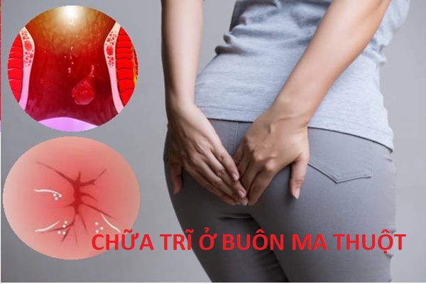 Chữa trĩ ở Buôn Ma Thuột